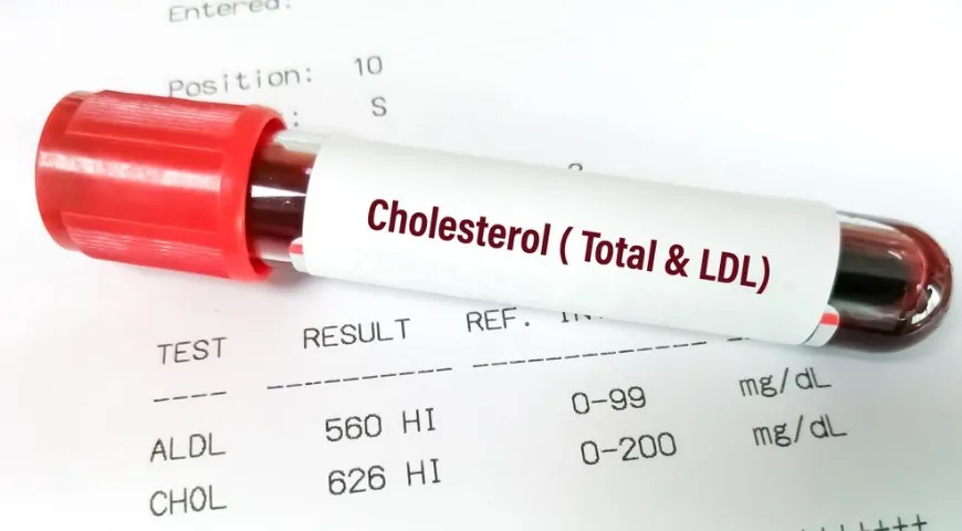 Nicht nur der Gesamtcholesterinspiegel ist wichtig, sondern auch das Lipoproteinverhältnis 